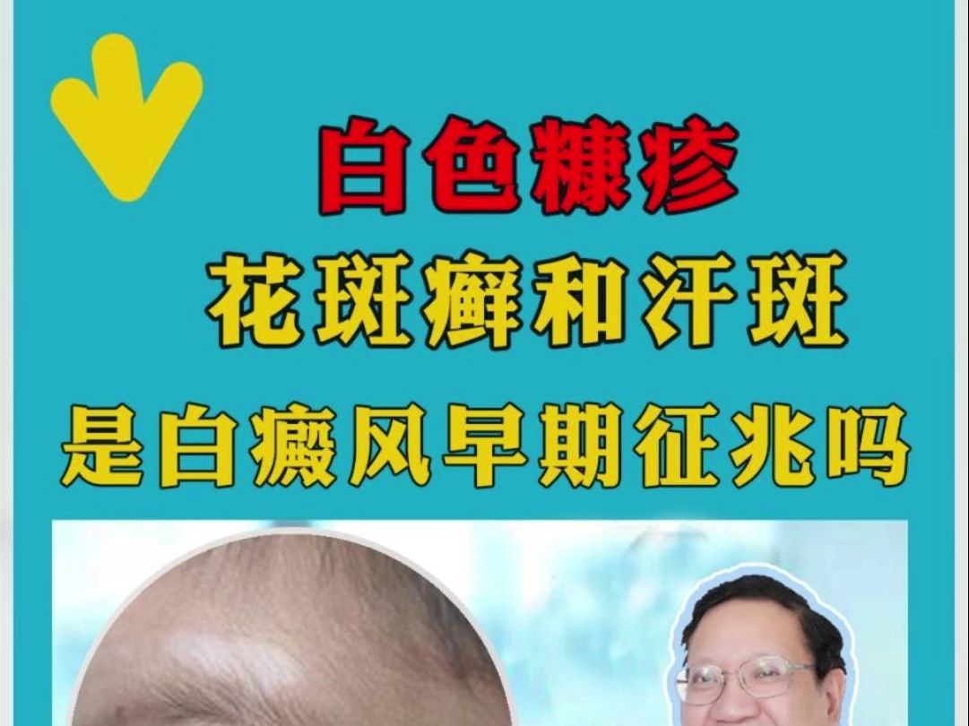 广东白癜风医院单孔荣教授介绍:白色糠疹,花斑癣和汗斑是白癜风早期