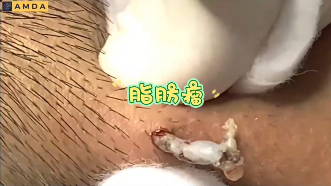 脂肪粉瘤哔哩哔哩bilibili