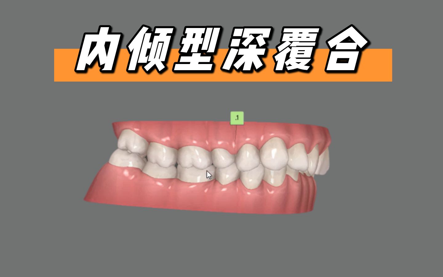 华西博士|内倾型深覆合,不拔牙矫治,打开咬合,压低前牙_哔哩哔哩_bili