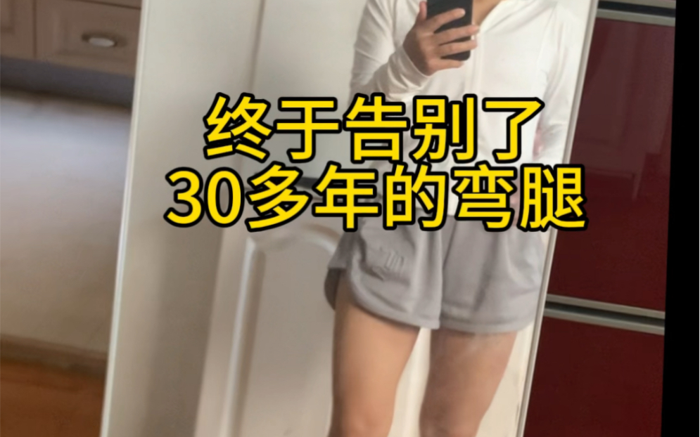 弯了30多年的腿终于直了#直腿#xo型腿#腿型不直哔哩哔哩bilibili