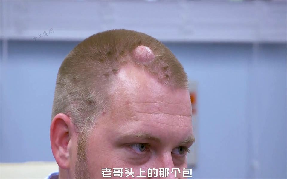 老哥头上长了个包,猜猜挤出来会有怎么的惊喜?