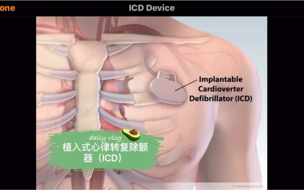 ICD植入式心律转复除颤器哔哩哔哩bilibili