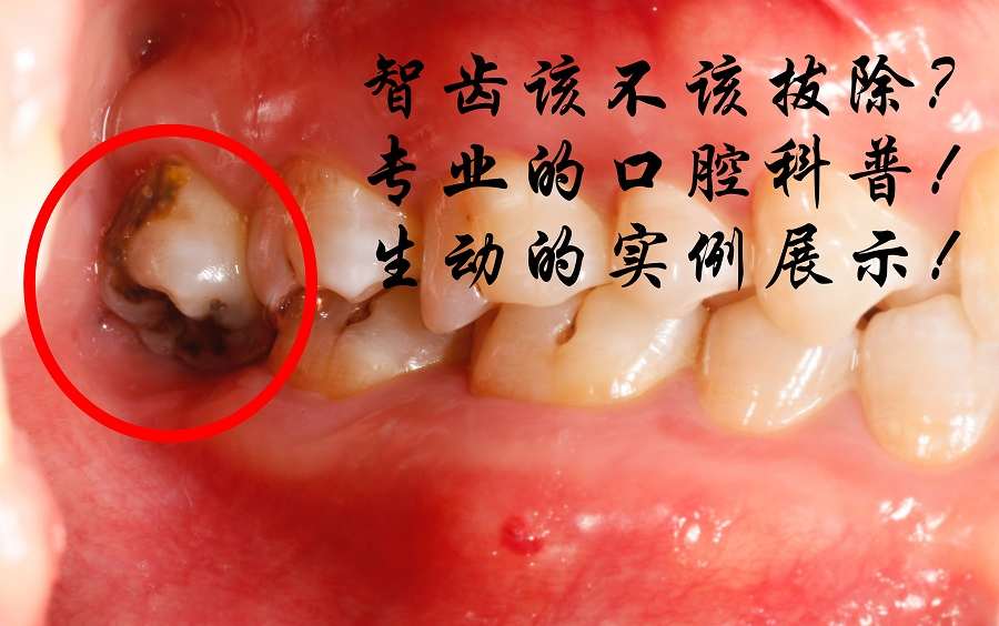 犹豫智齿拔不拔?看完全知道!智齿科普,纯干货,请君对号入座......哔哩哔哩bilibili