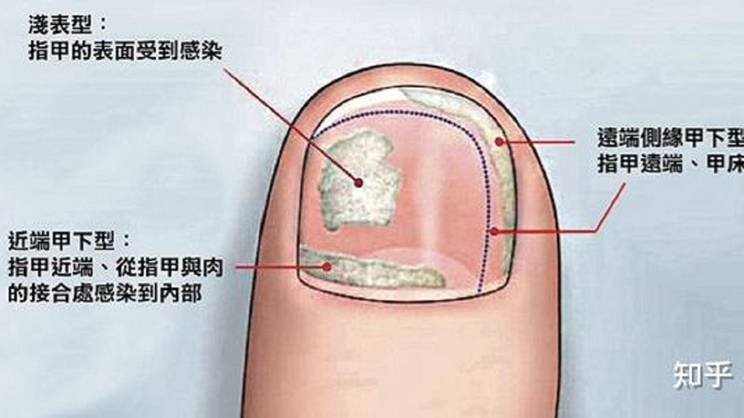 不同类型的灰指甲怎么治?方法大揭秘!哔哩哔哩bilibili