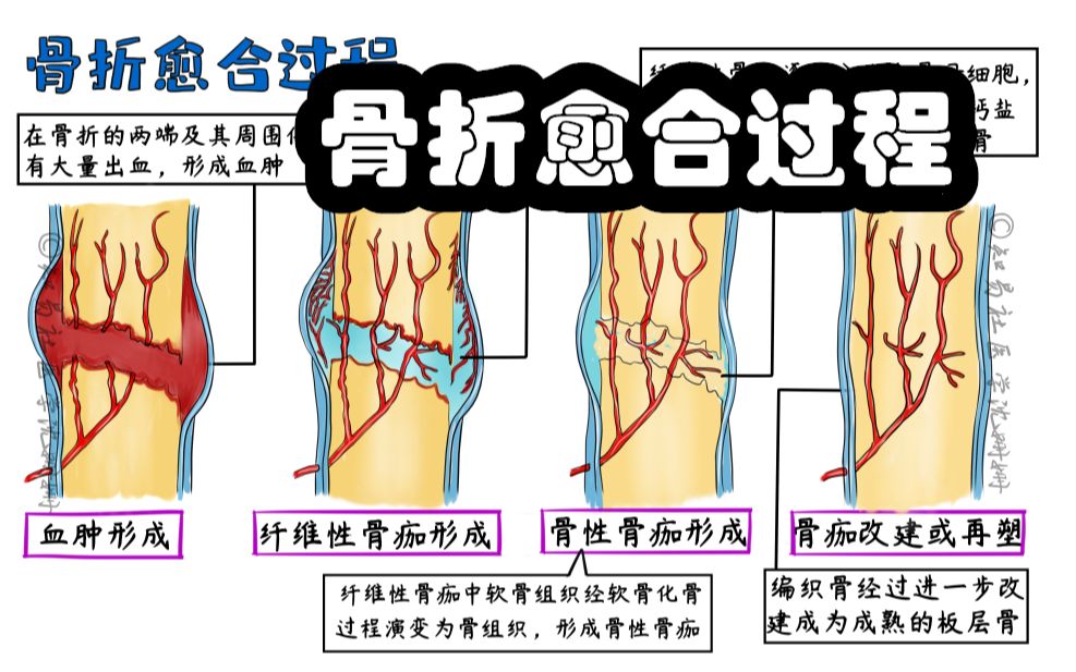 骨折愈合过程图片