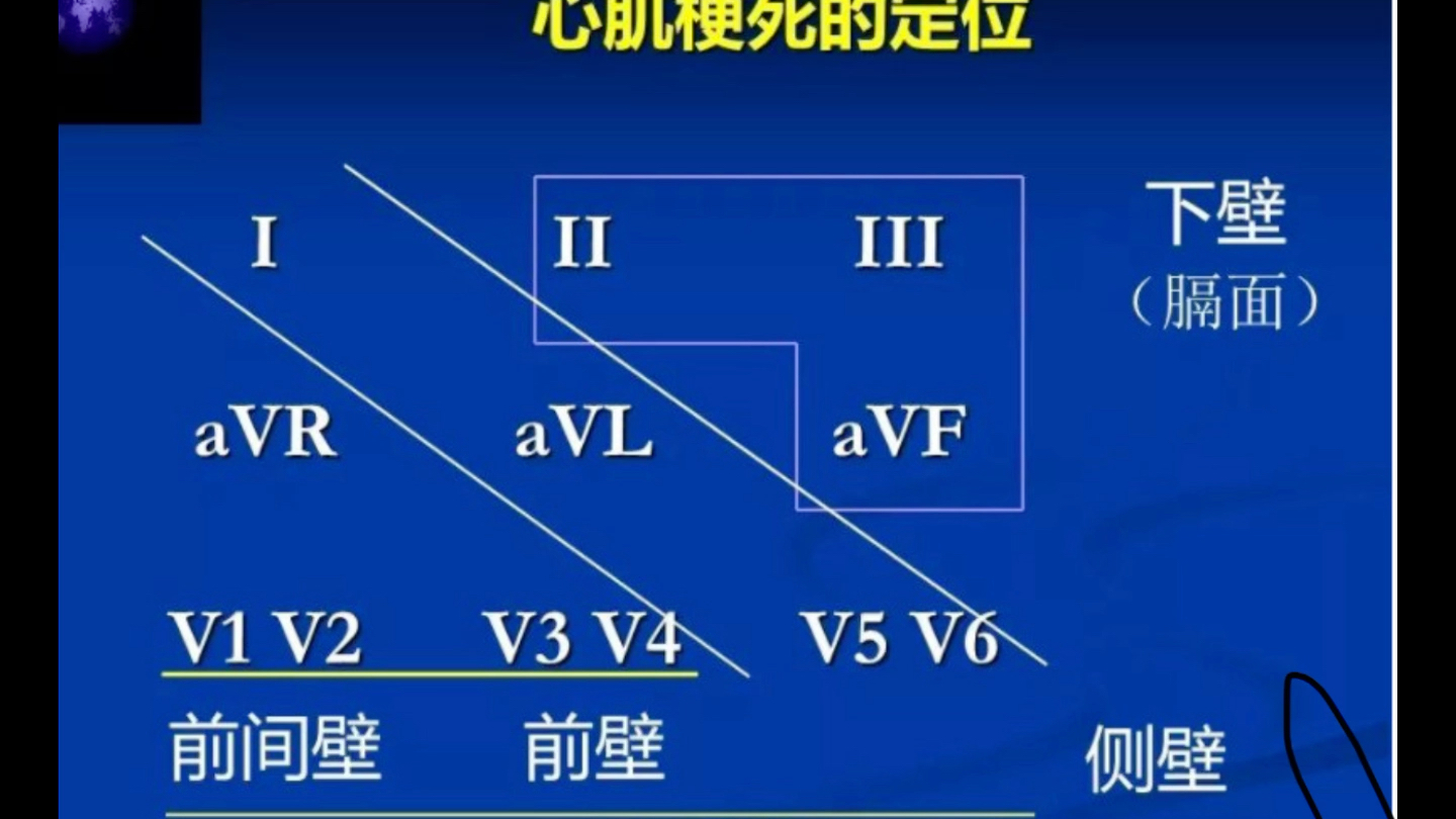 心电图心梗分区图片