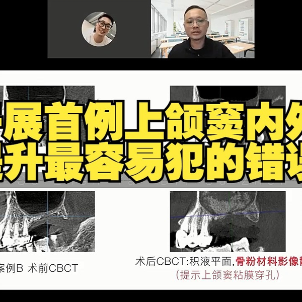 四川大学华西口腔医院苏镇亚博士《开展首例上颌窦内外提升最容易犯的