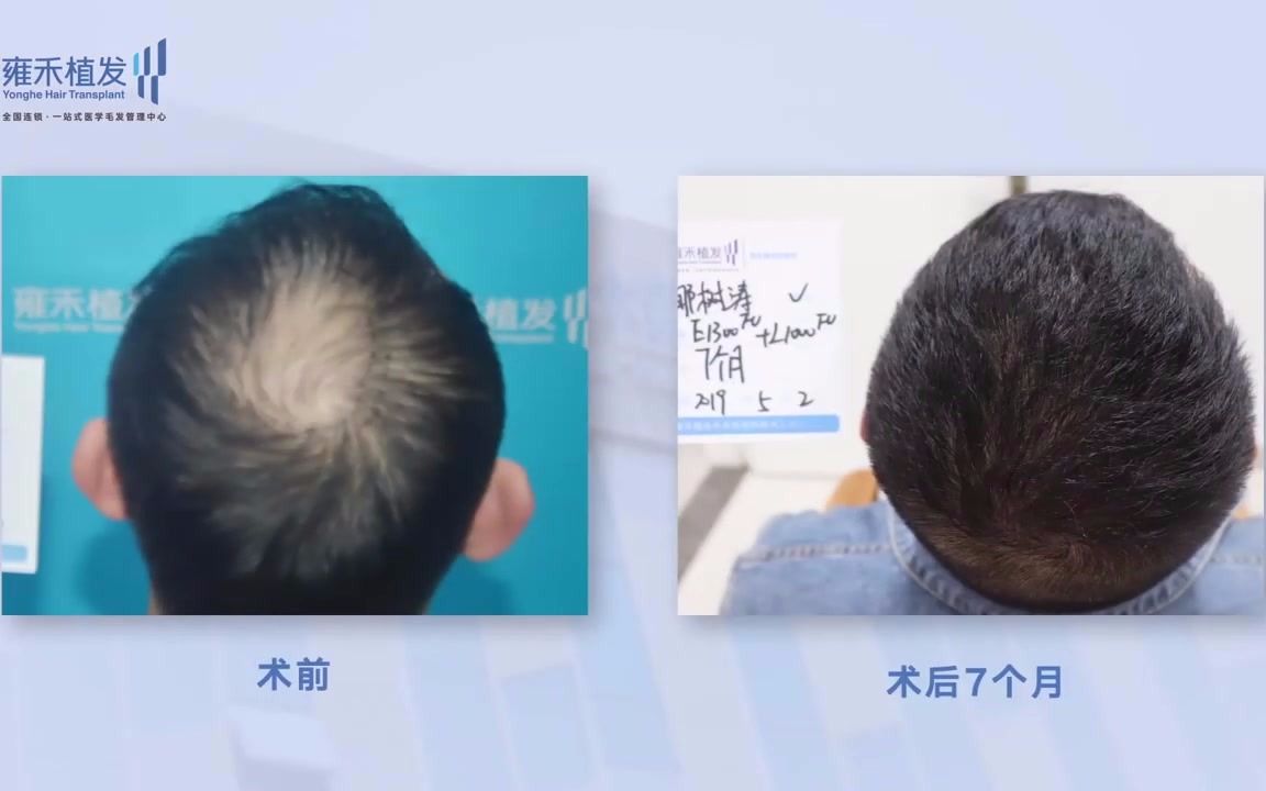 [图]頭髮稀疏怎麼辦？雍禾植髮有效果嗎？Yonghe hair transplant