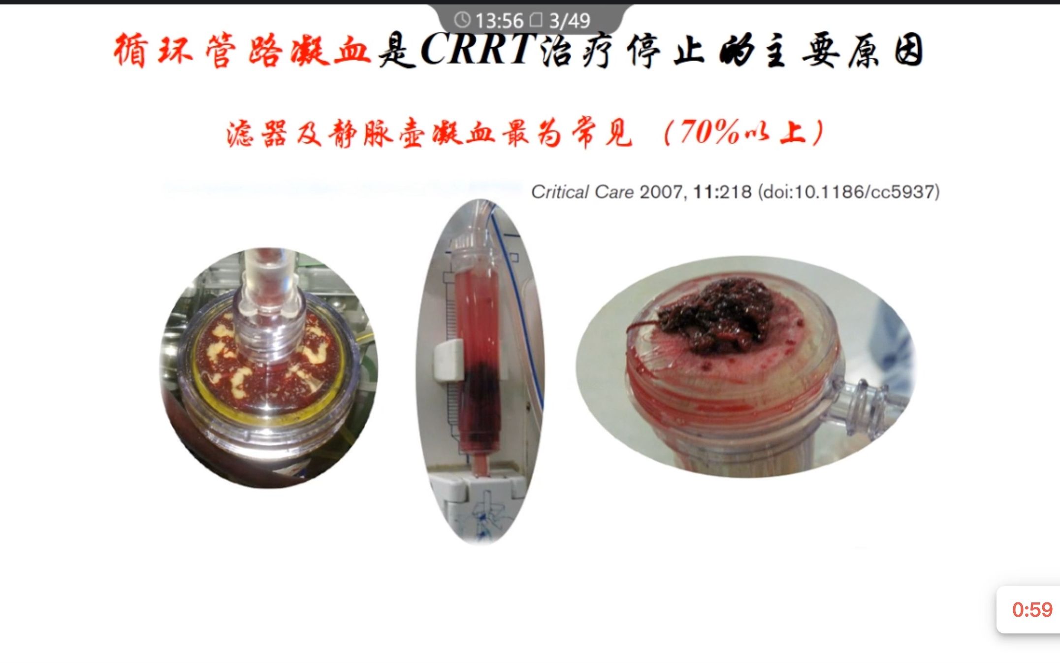 CRRT抗凝之萘莫司他华西张凌哔哩哔哩bilibili