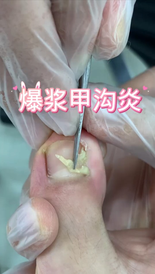 修甲沟炎居然爆浆了