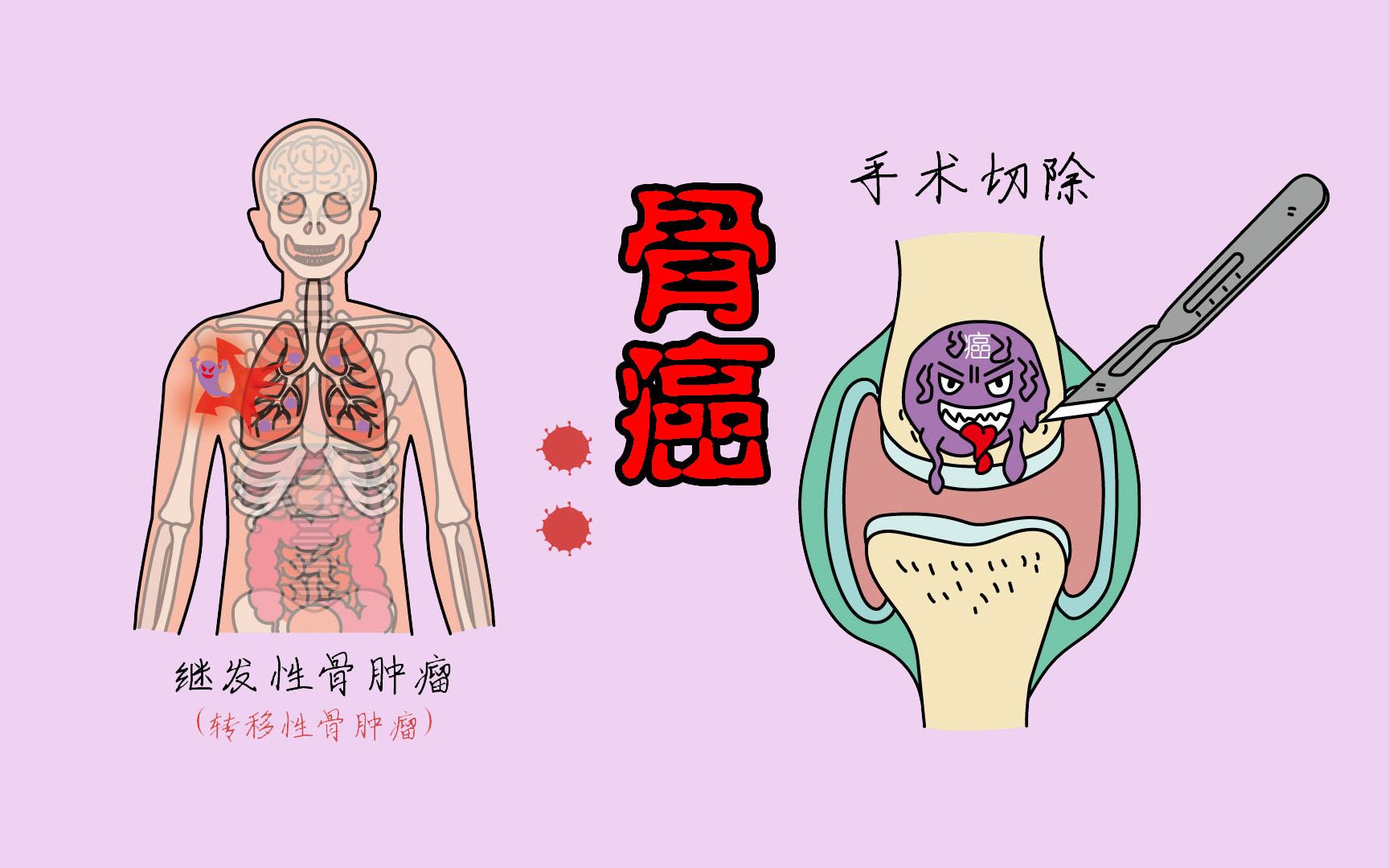 患上骨癌,这5个"异常"会不断显现_哔哩哔哩_bilibili