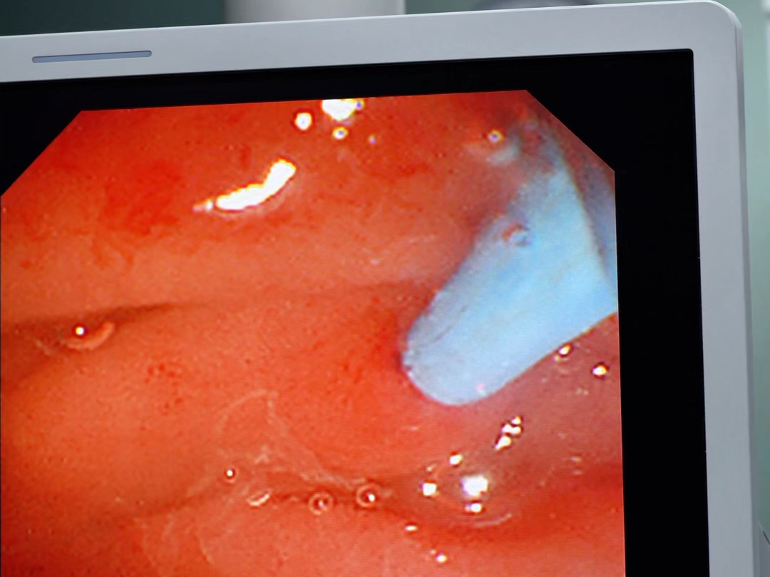 杨主任带你了解慢性胰腺炎胰管结石的综合治疗