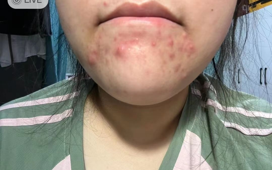 下巴痤疮痘痘如何清除?最有效的几个方法,掌握一个痘痘唰唰掉!