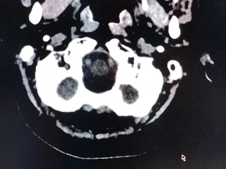 左侧小脑半球是软化灶还是大枕大池还是蛛网膜膜囊肿,如何确诊?哔哩哔哩bilibili