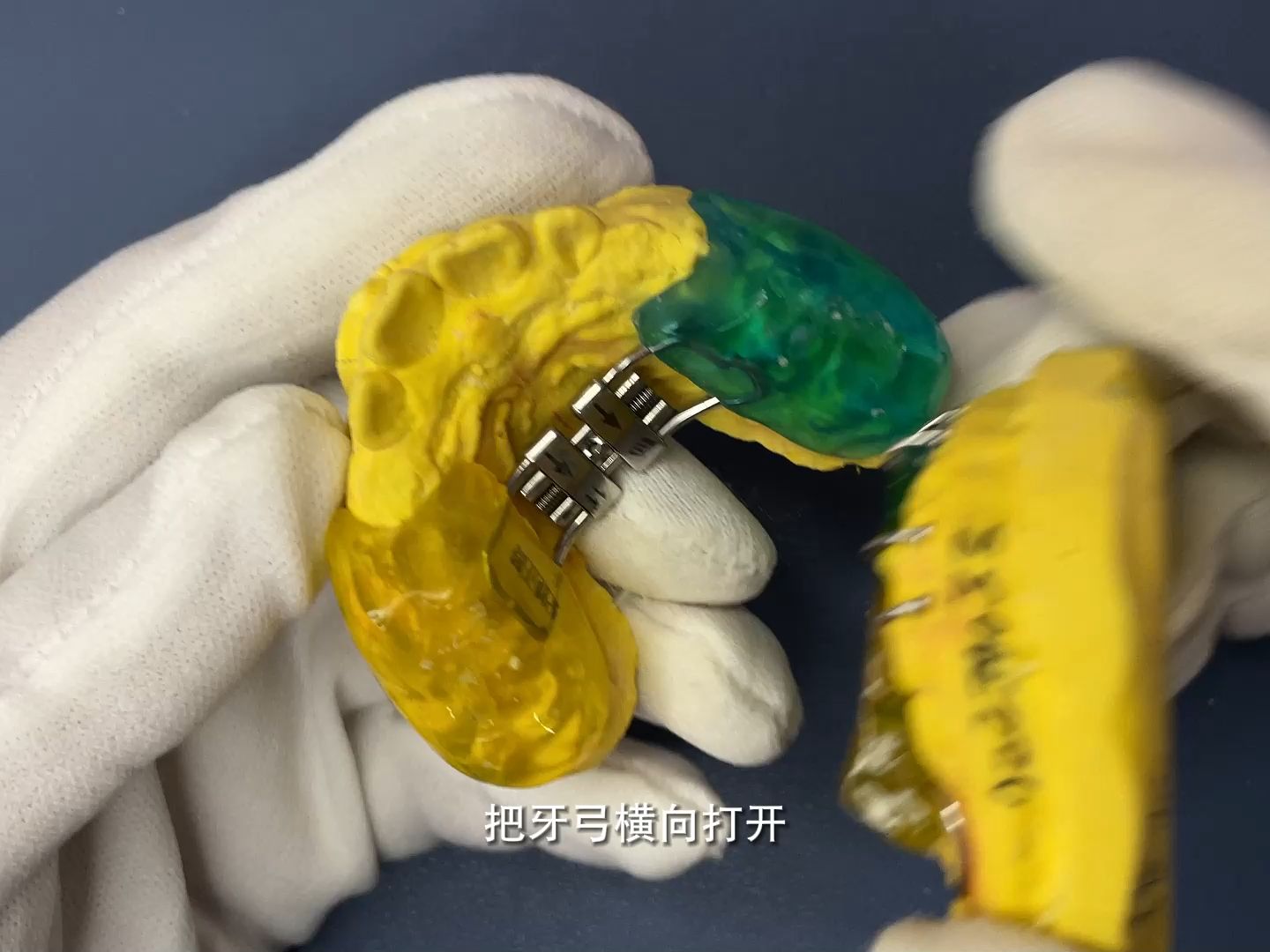 sgtb矫正器 妃她正畸