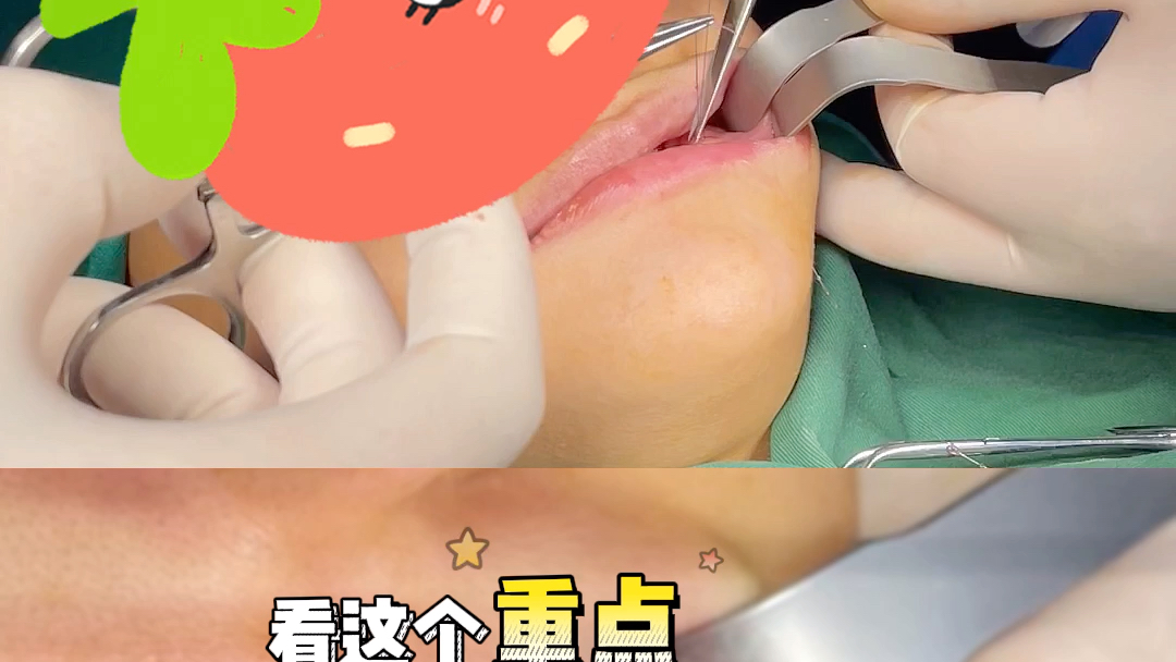 取颊脂垫手术操作中