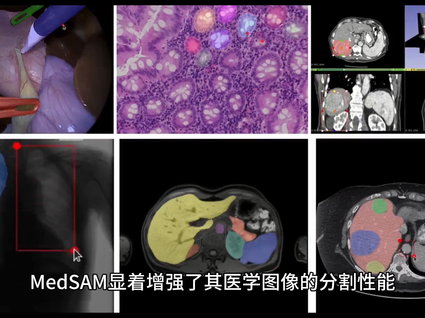 0129 MEDSAM医学图像分割模型哔哩哔哩bilibili