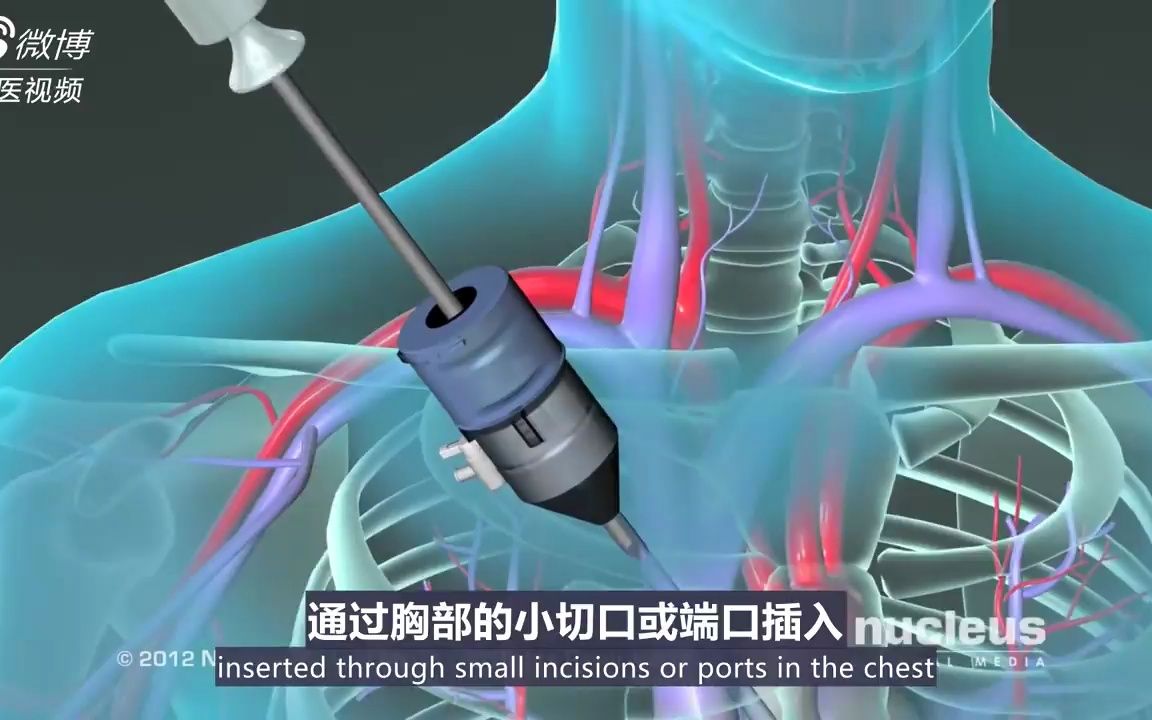 [图]科普纪录片，冠状动脉搭桥术。