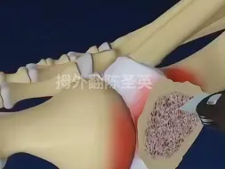 Descargar video: 【陈圣英】3d动画演示 拇外翻传统和微孔手术区别，一定要切掉一块骨头？