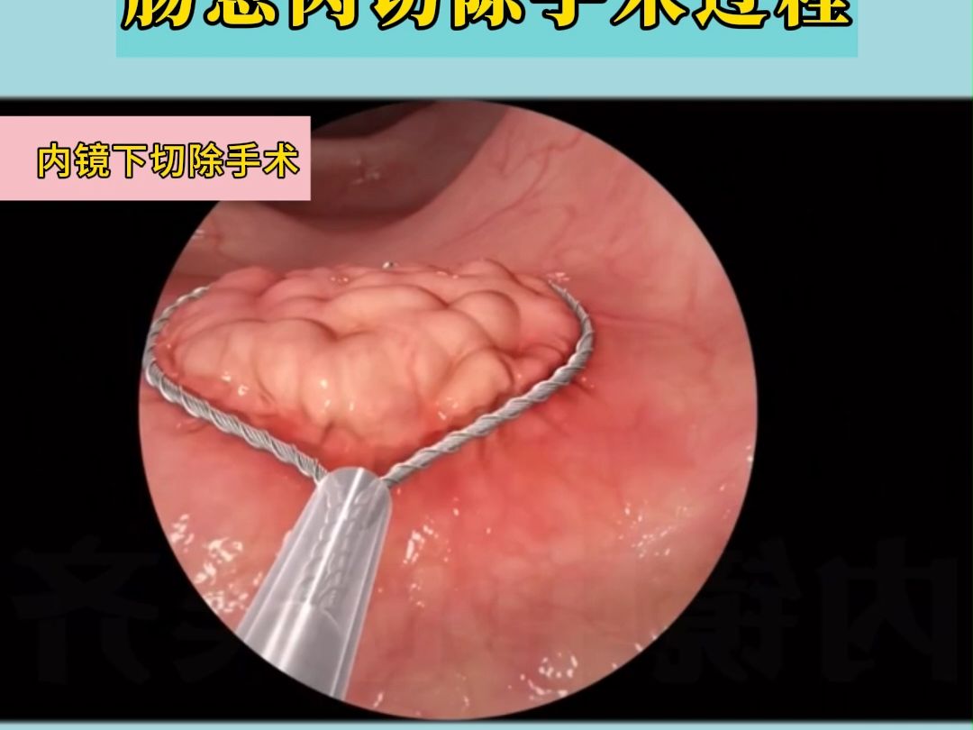 3D动画展示内镜下,肠息肉切除手术过程哔哩哔哩bilibili