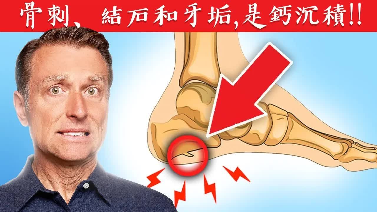 长骨刺,结石和牙结石,钙沉积8原因,自然疗法,柏格医生dr berg哔哩哔哩bilibili