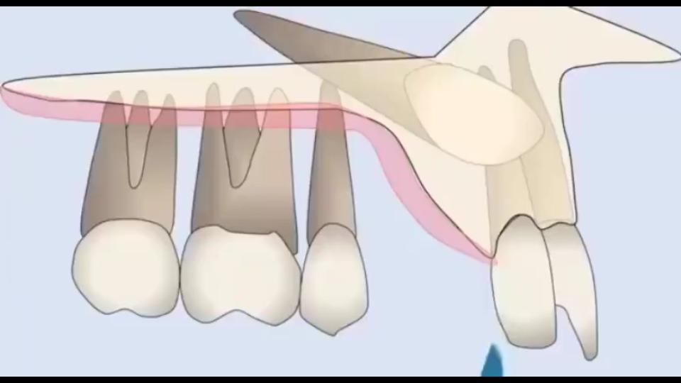 非智齿埋伏牙,通过正畸牵引如何导出的呢?看这个视频你就懂了