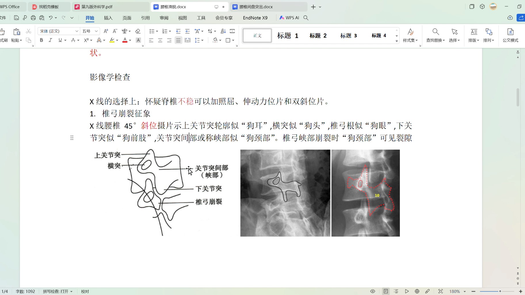 脊柱外科之腰椎滑脱