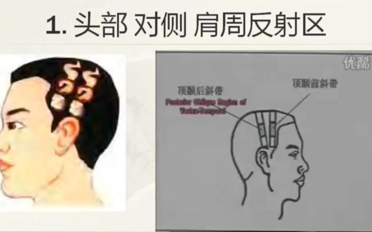 零基础学刮痧2 轻松治疗肩周炎, 六步全息经络刮痧.哔哩哔哩bilibili