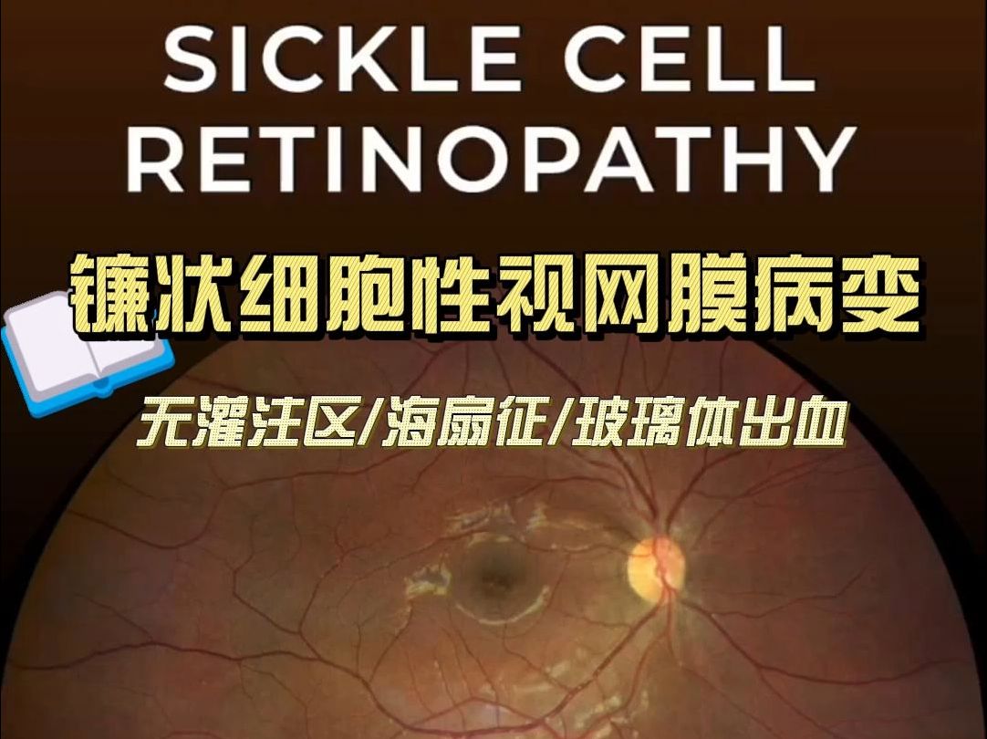 【镰状细胞性视网膜病变】Proliferative Sickle Cell Retinopathy哔哩哔哩bilibili