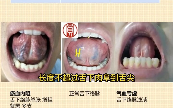 舌诊系列第11讲,舌下络脉的意义哔哩哔哩bilibili