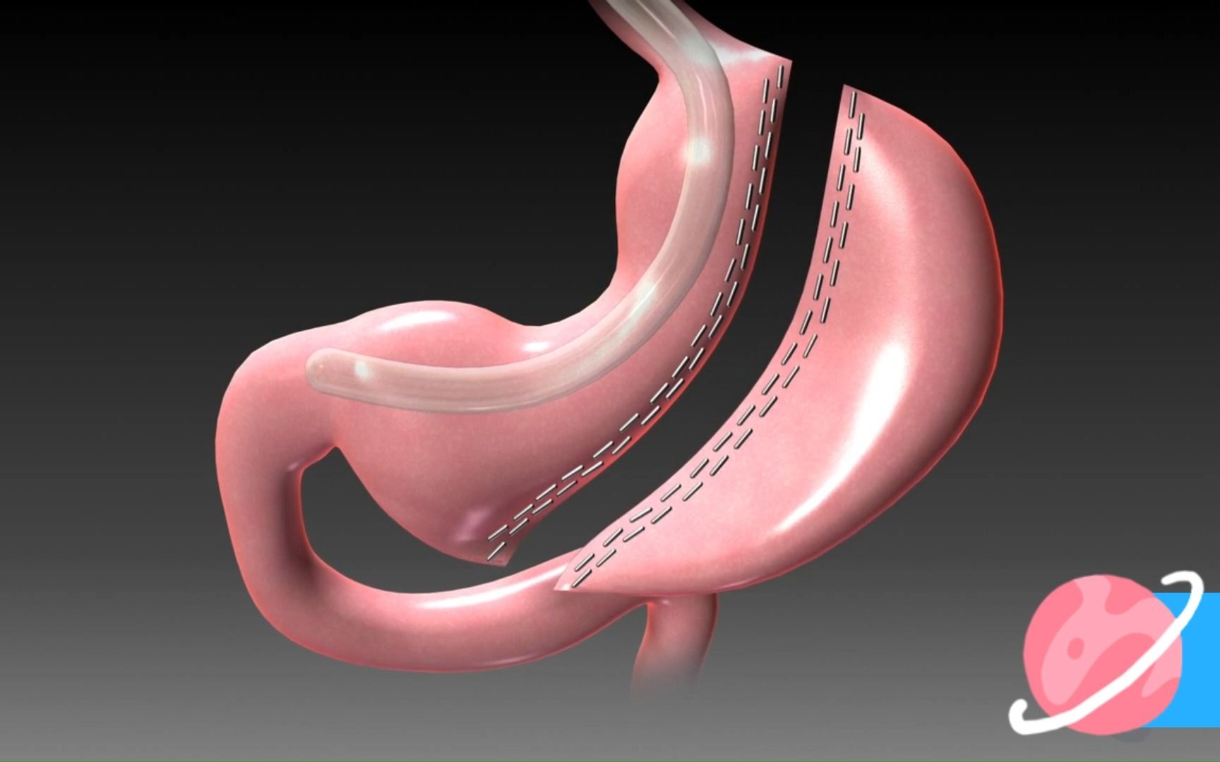 減肥神技 袖狀胃切除手術 #頑固性肥胖 #減肥 #減脂 #3d動畫 #科學