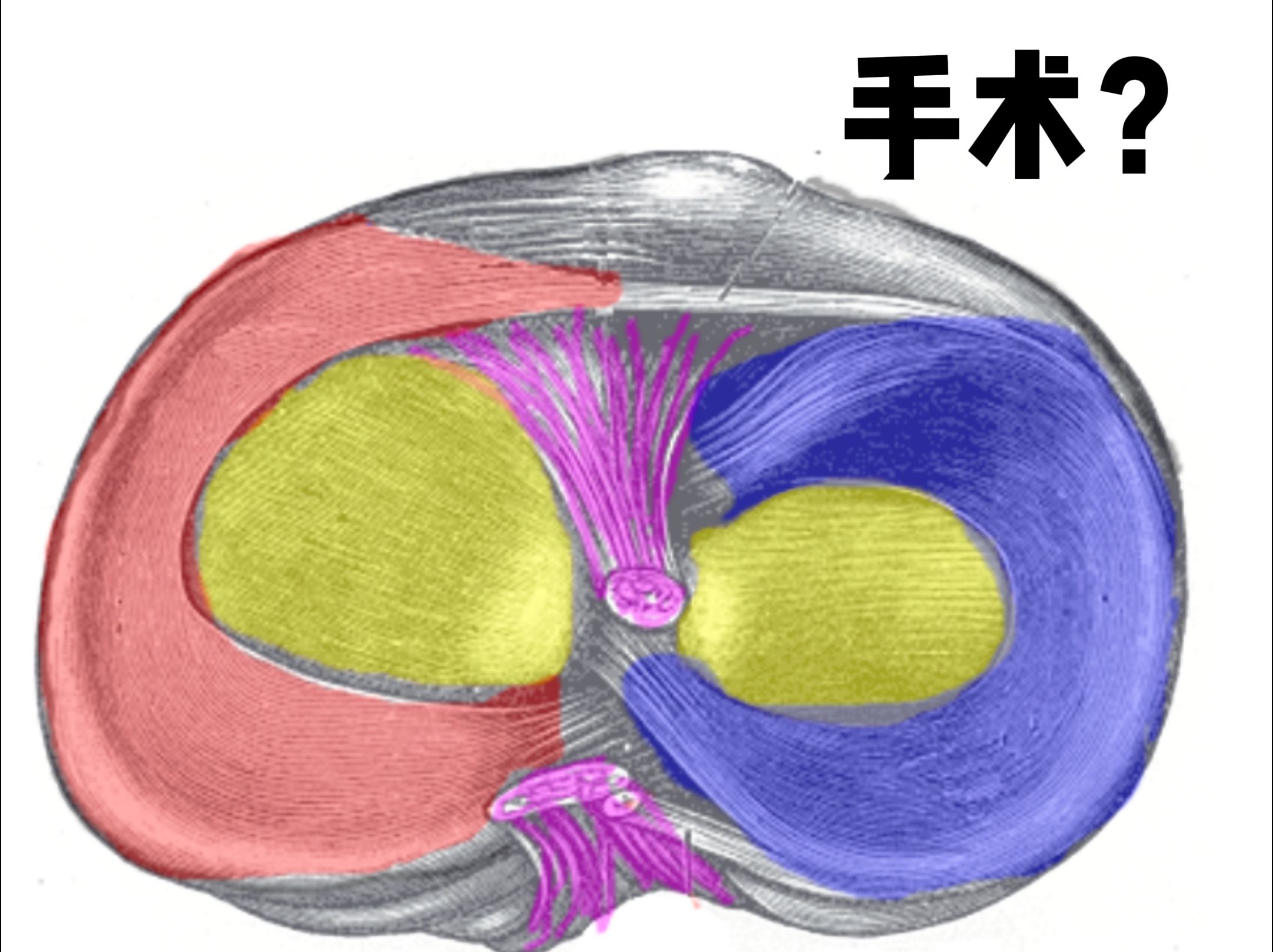 三度撕裂示意图图片