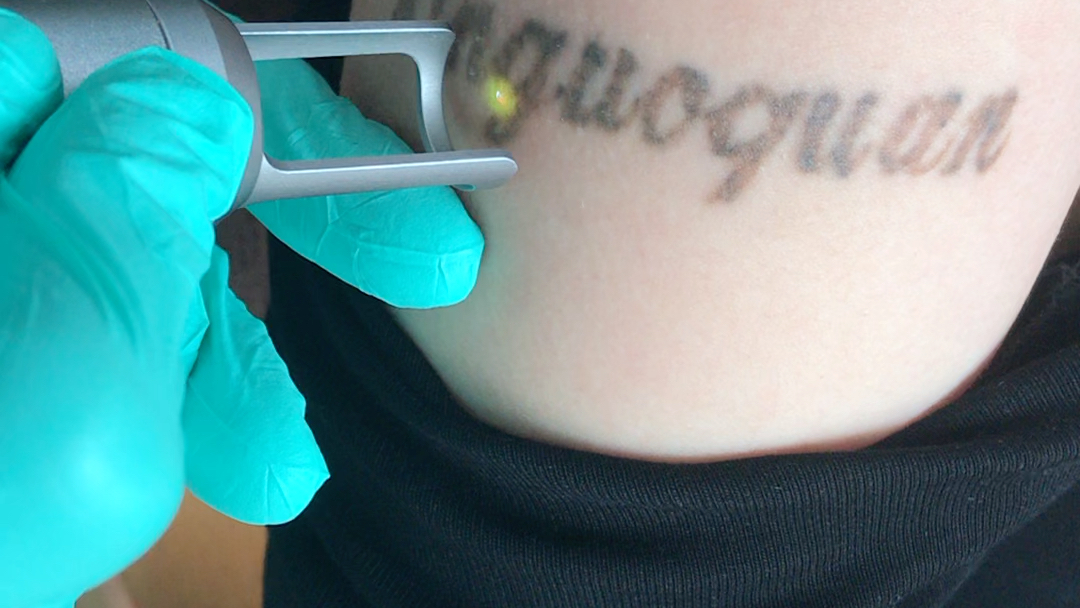 第二次洗纹身洗纹身第二次皮秒洗纹身深圳洗纹身东莞洗纹身中山洗纹身
