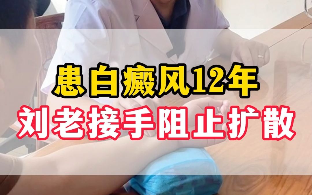 患白癜风12年 刘老接手阻止扩散哔哩哔哩bilibili