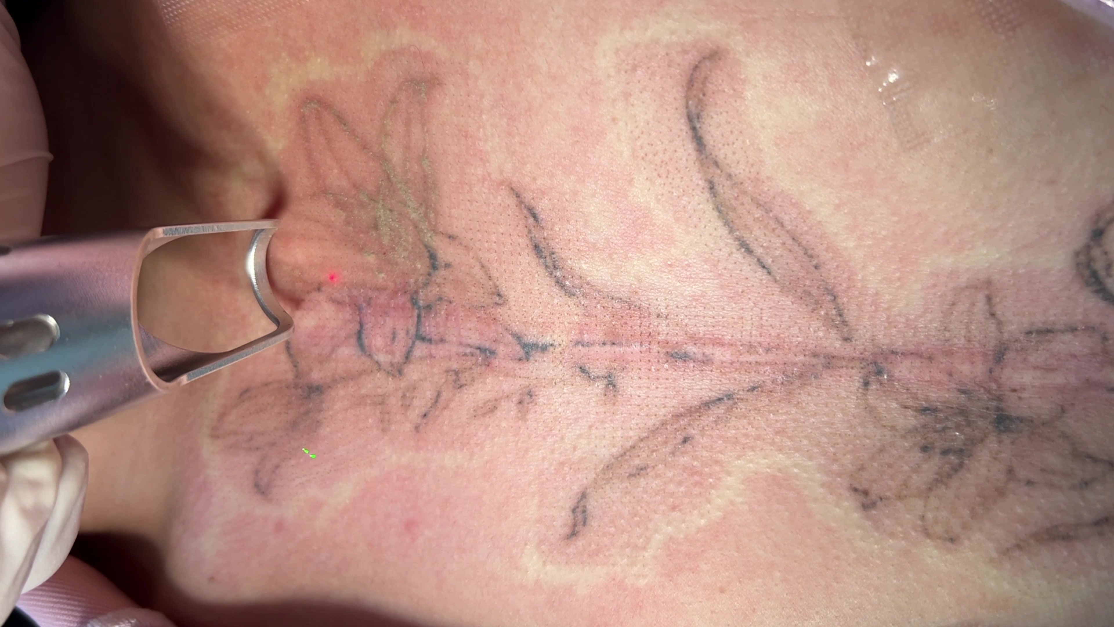 纹身清洗过程记录