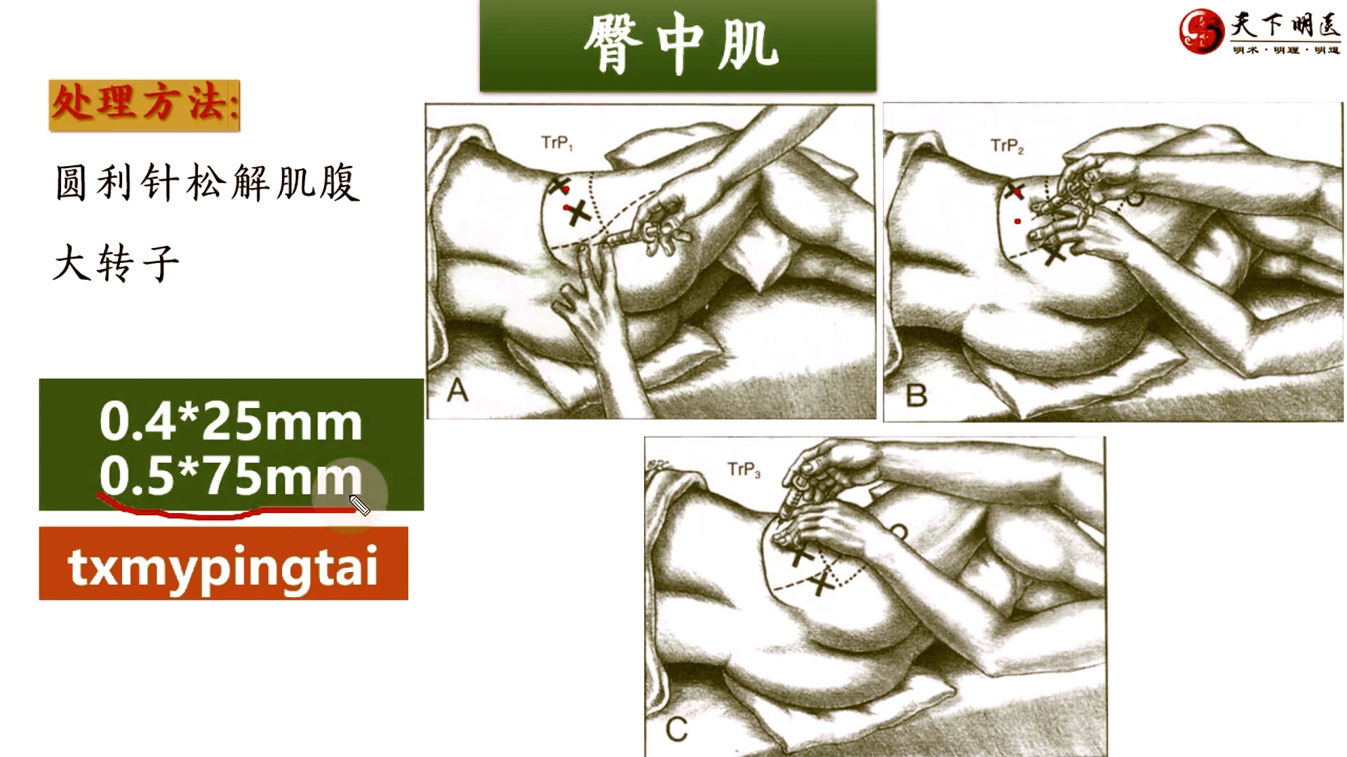 臀中肌的位置、臀中肌的功能、臀中肌的激痛点、臀中肌损伤后的症状、臀中肌的处理方法4个方面全方位讲解——天下明医平台简灵奇针尹振汉讲解哔哩哔...