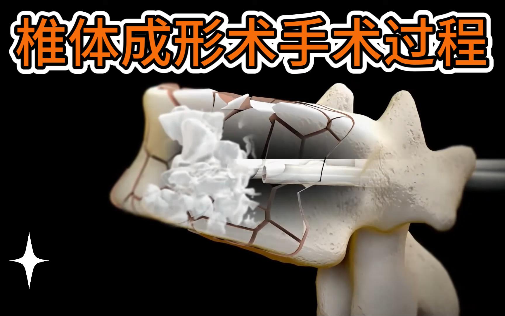 椎体成形术完整过程