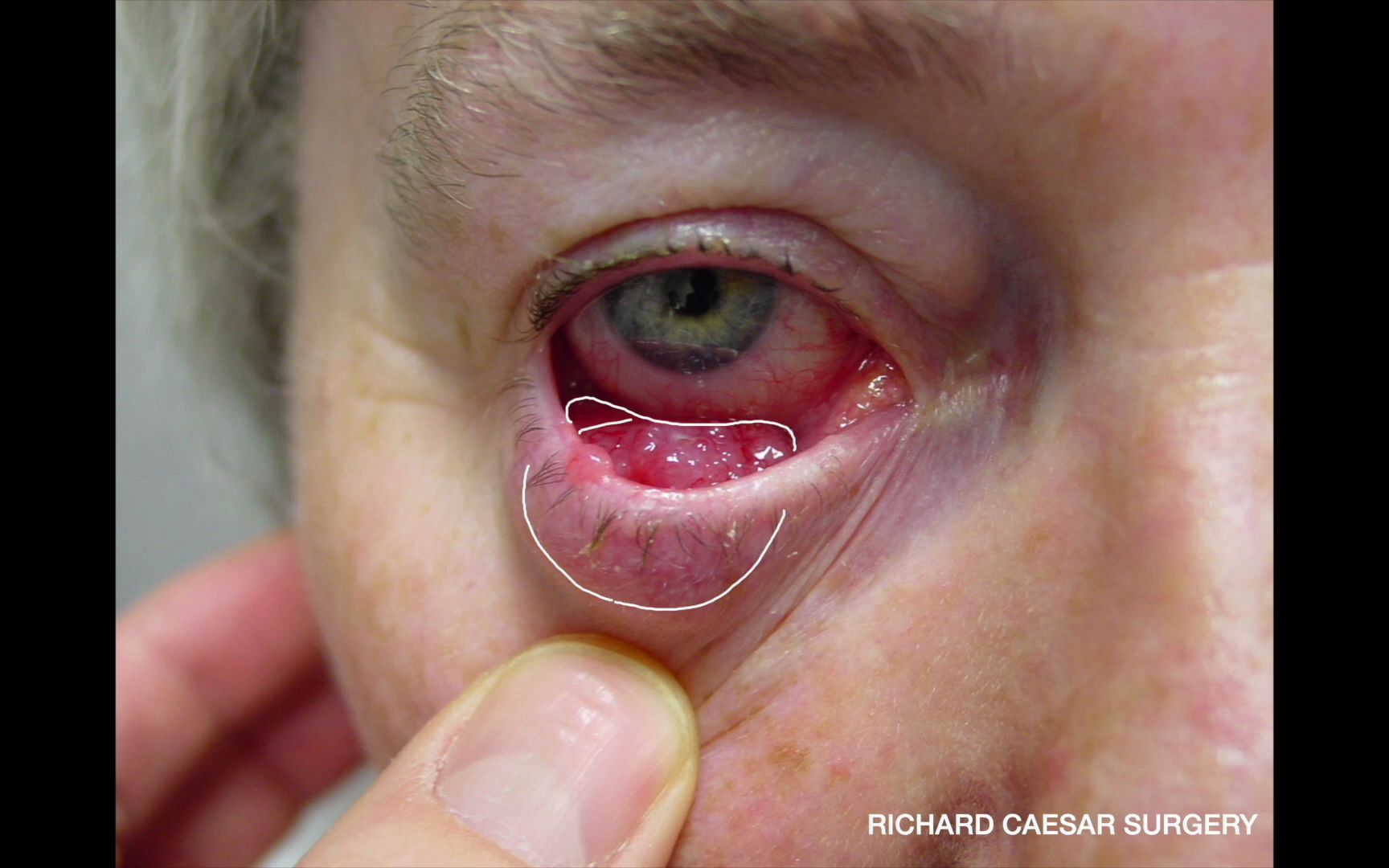 【中英双字】【睑外翻手术实例】 lower eyelid ectropion a