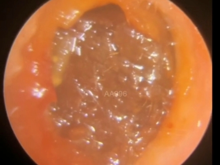 从美女的耳道里面挖出来一个像老鼠屎和面包一样的耵聍