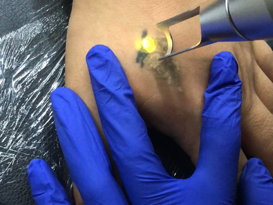 超皮秒激光清洗纹身不留疤