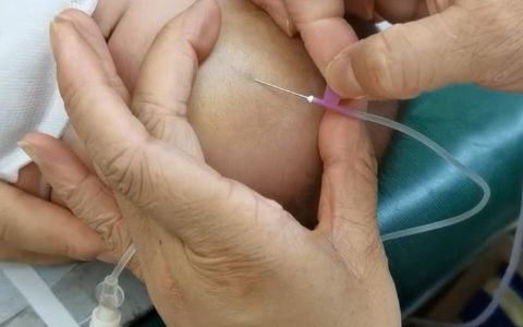 头部静脉输液学习分享,技术一流!