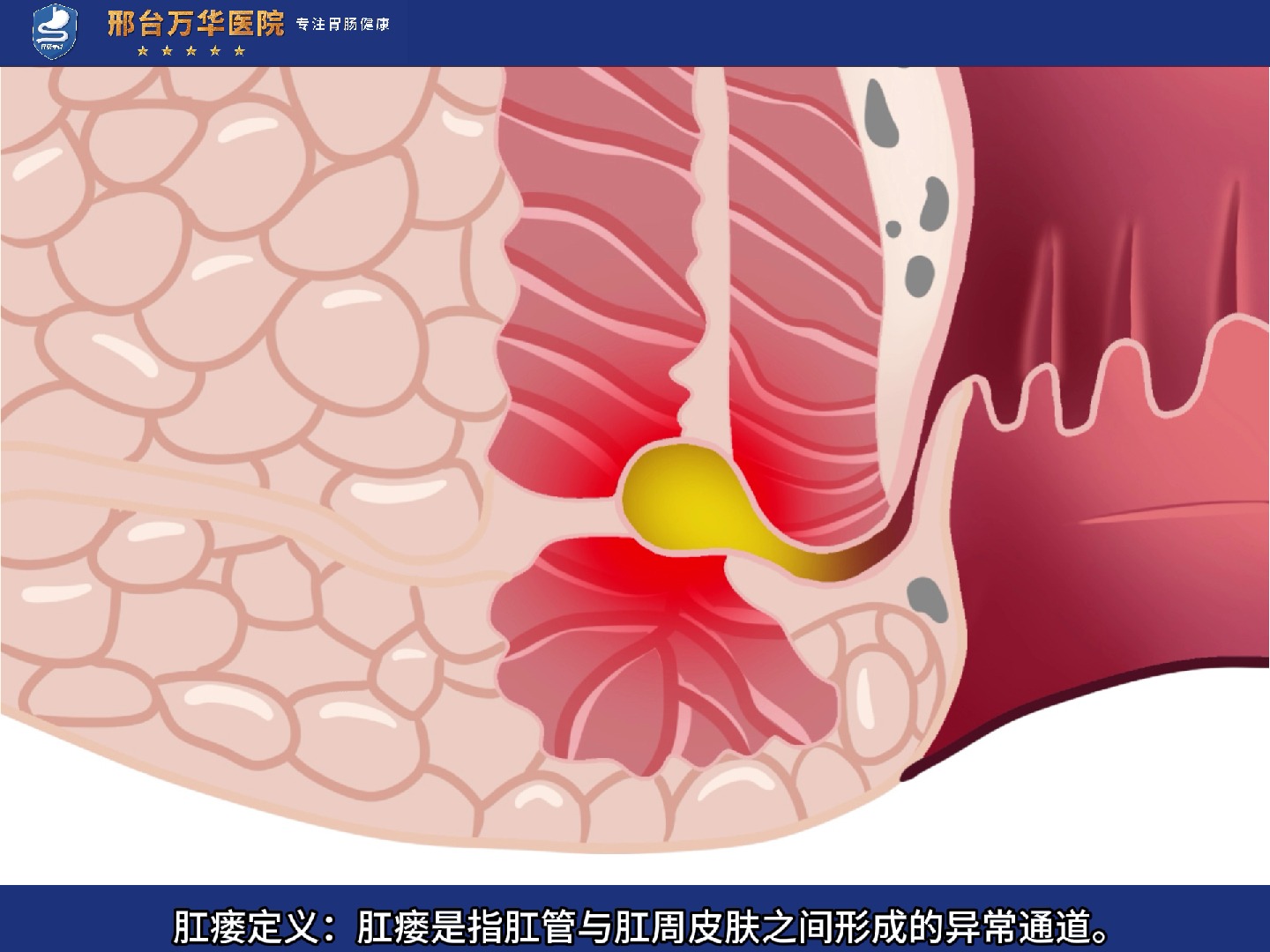 肛瘘的位置图片