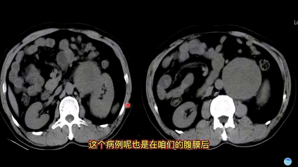 典型病例分享:腹膜后常见肿瘤之一,在CT上影像特征较强哔哩哔哩bilibili