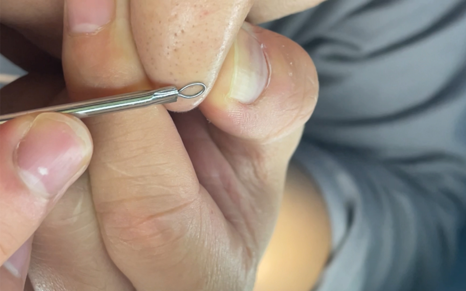 超解压挤黑头,痛快