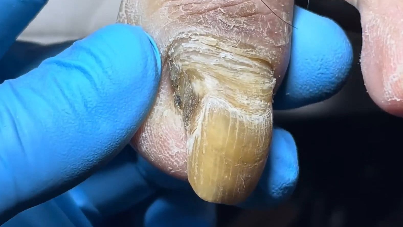 超脏灰指甲,得有一年没剪了