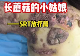 Download Video: 【SRT放疗】蘑菇姑娘今天来做SRT了，拆线的肉疙瘩已经平整了