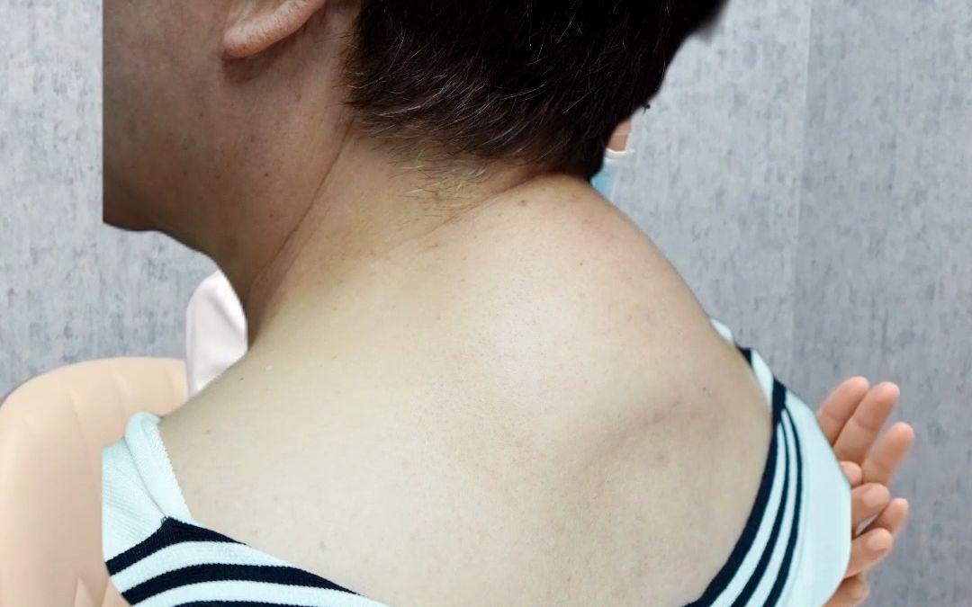 富贵包3种手术方式大揭秘,看看哪种更好!