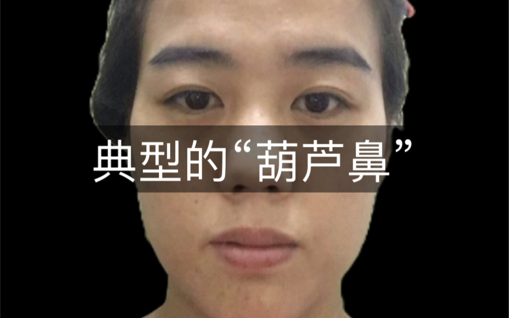 典型的"葫芦鼻",一生过的比较辛苦!