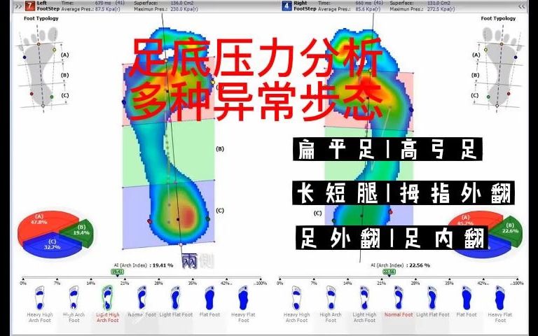 足底压力分析多种异常步态扁平足高弓足长短腿拇指外翻足外翻足内翻等哔哩哔哩bilibili