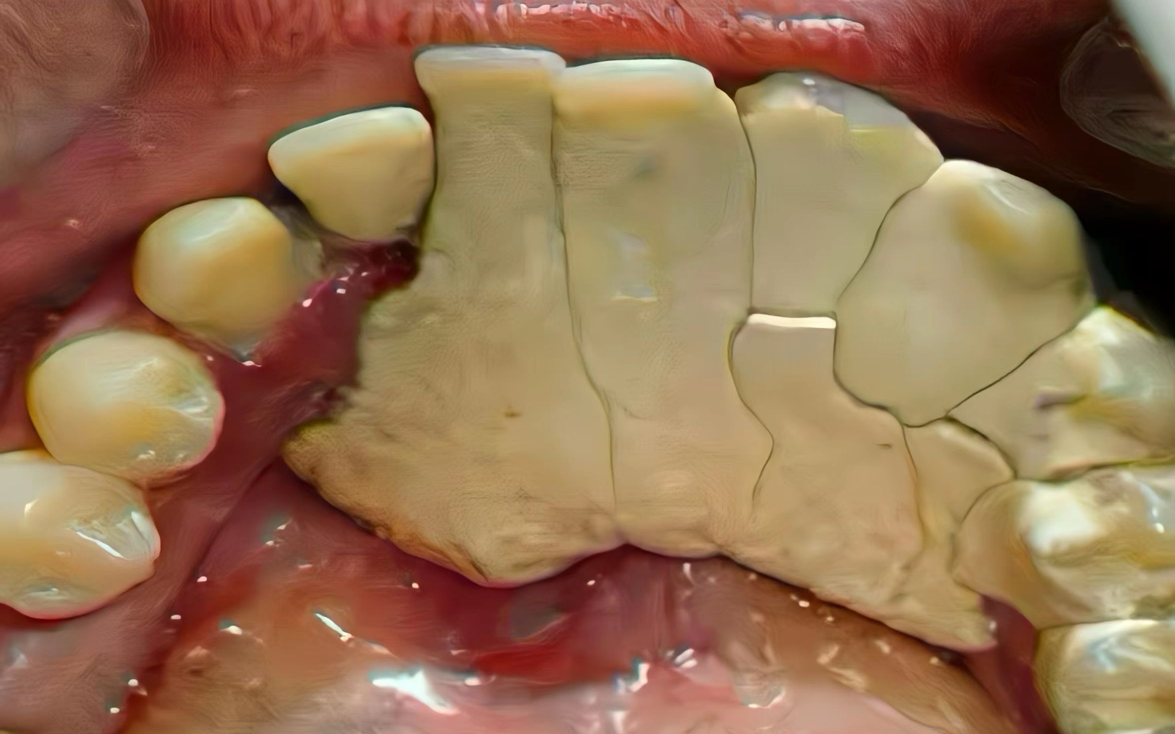 5年牙结石根除经验分享!学会这一招,发硬发臭的牙结石瞬间没了!
